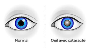 œil cataracte