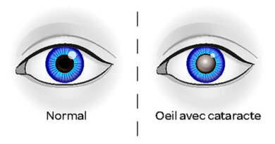 œil cataracte